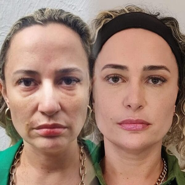 Protocolo Afrodite – Harmonização Facial - Imagem 2