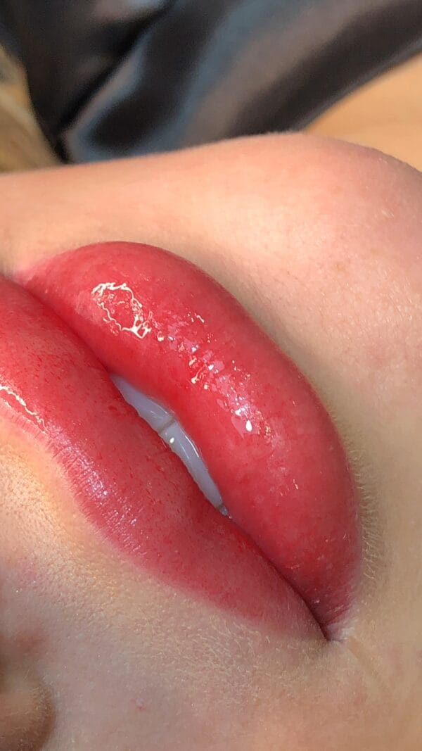 Preenchimento Labial com Ácido Hialurônico - Imagem 2