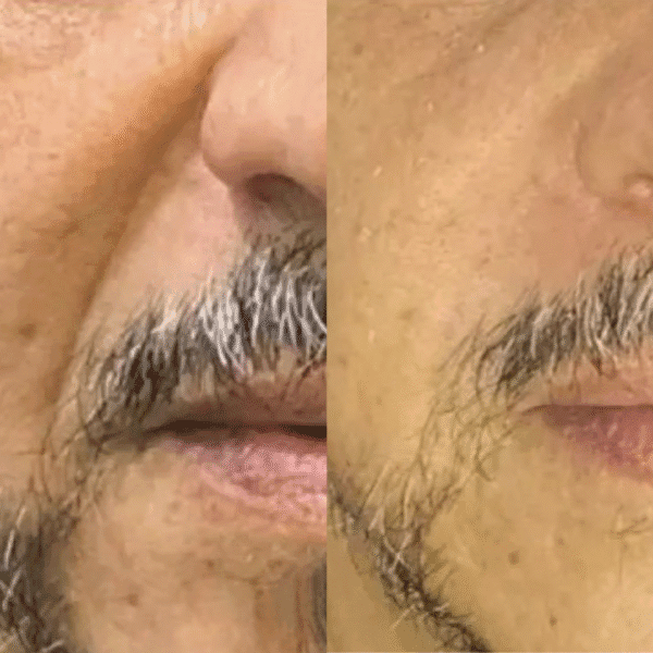 Preenchimento do Bigode Chinês - Imagem 2