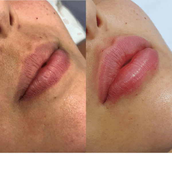 Preenchimento Labial com Ácido Hialurônico - Imagem 3