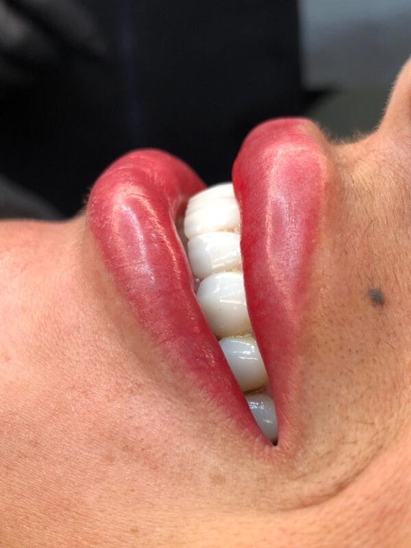 Preenchimento Labial com Ácido Hialurônico - Imagem 4