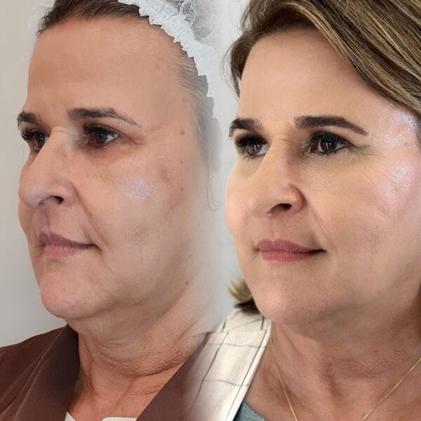 Protocolo Afrodite – Harmonização Facial - Imagem 5
