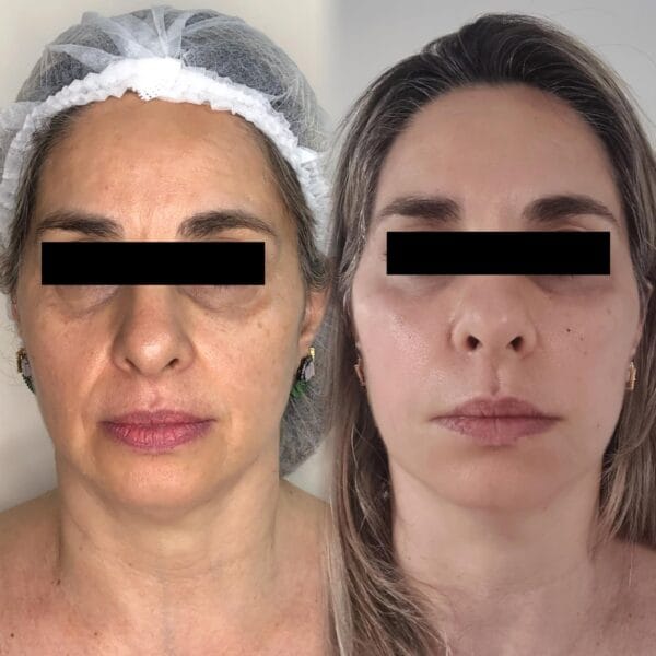 Protocolo Afrodite – Harmonização Facial - Imagem 4