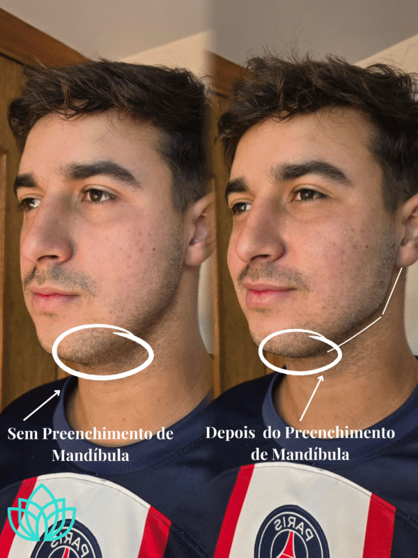 Preenchimento de Mandíbula - Imagem 4